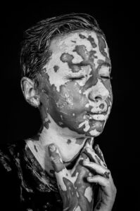 ニキビ跡の色素沈着を効果的に治療する方法は？